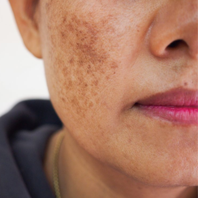 Pigmentation
